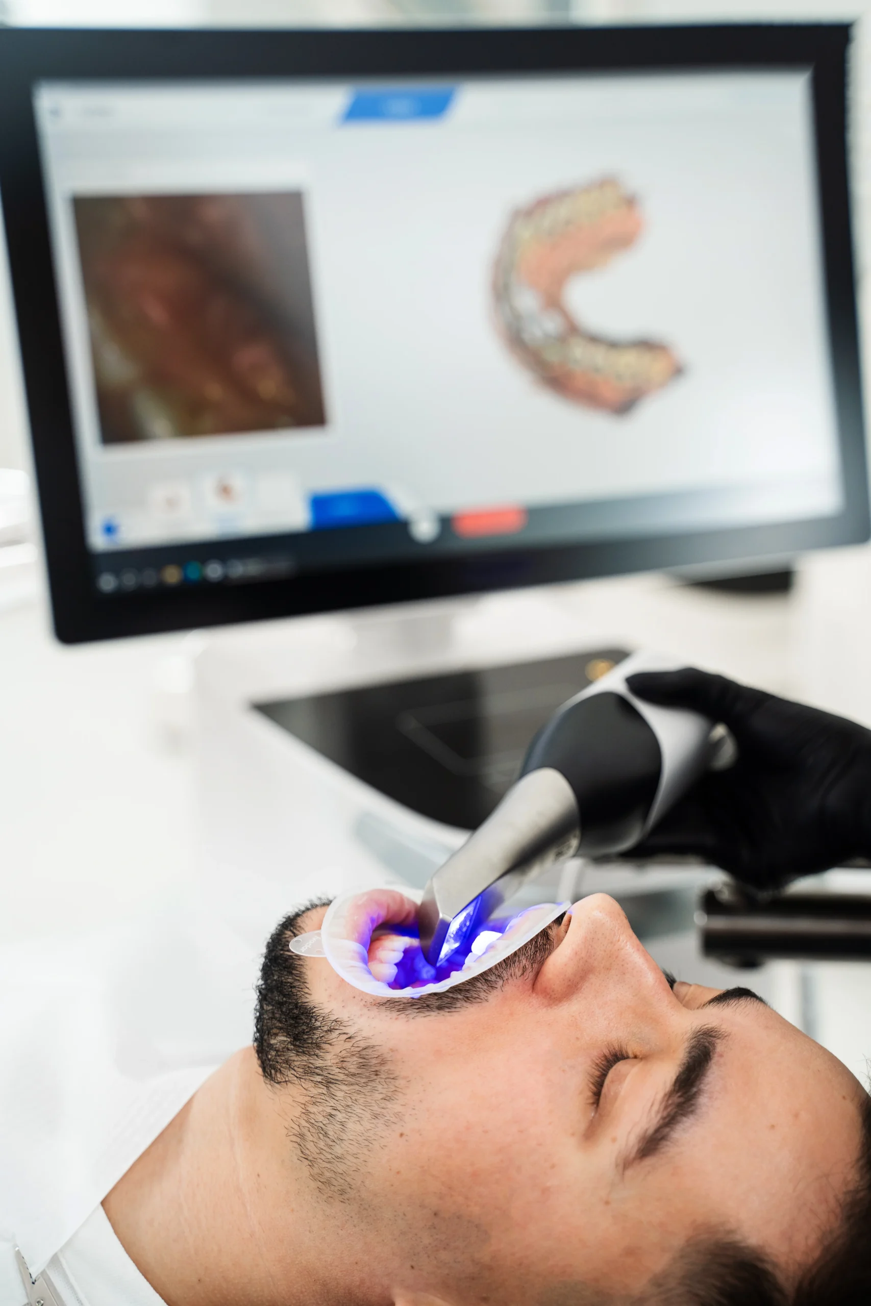 Escáner intraoral tomando el molde digital de la boca de un paciente