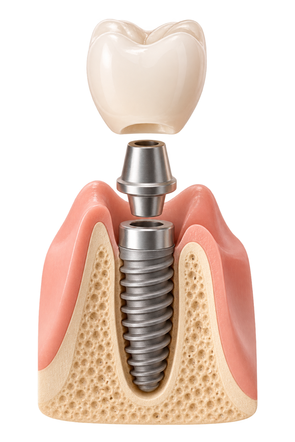 Partes de un implante dental: corona, pilar y tornillo de titanio