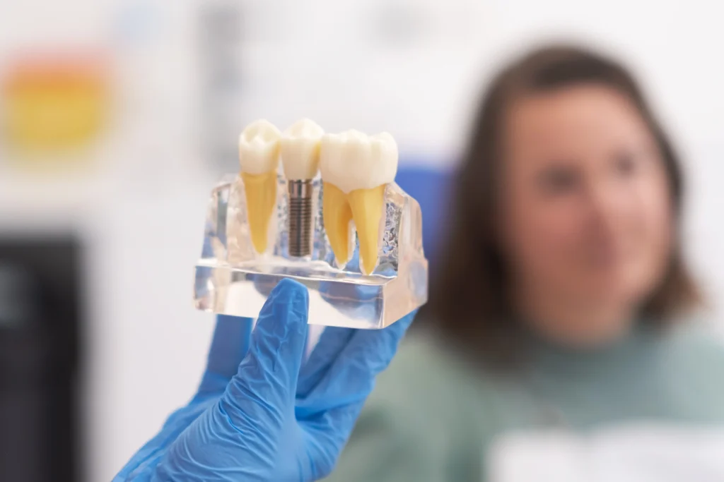 ¿Cuánto dura un implante dental?