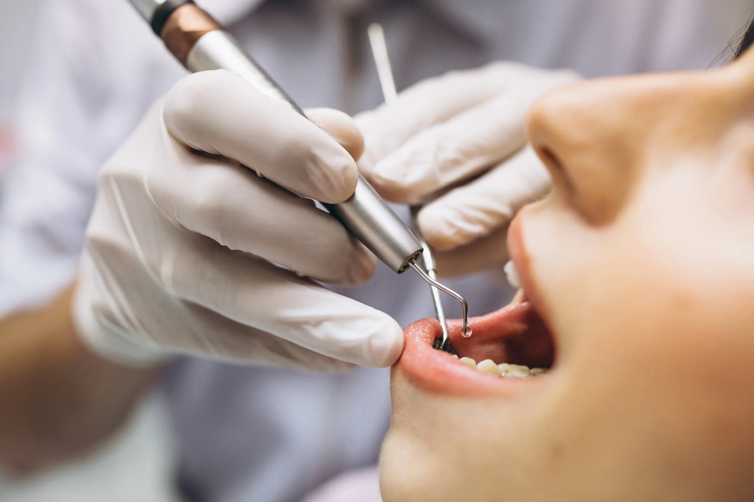 Endodoncia en la clínica Dental Agudo Rosa en Albacete