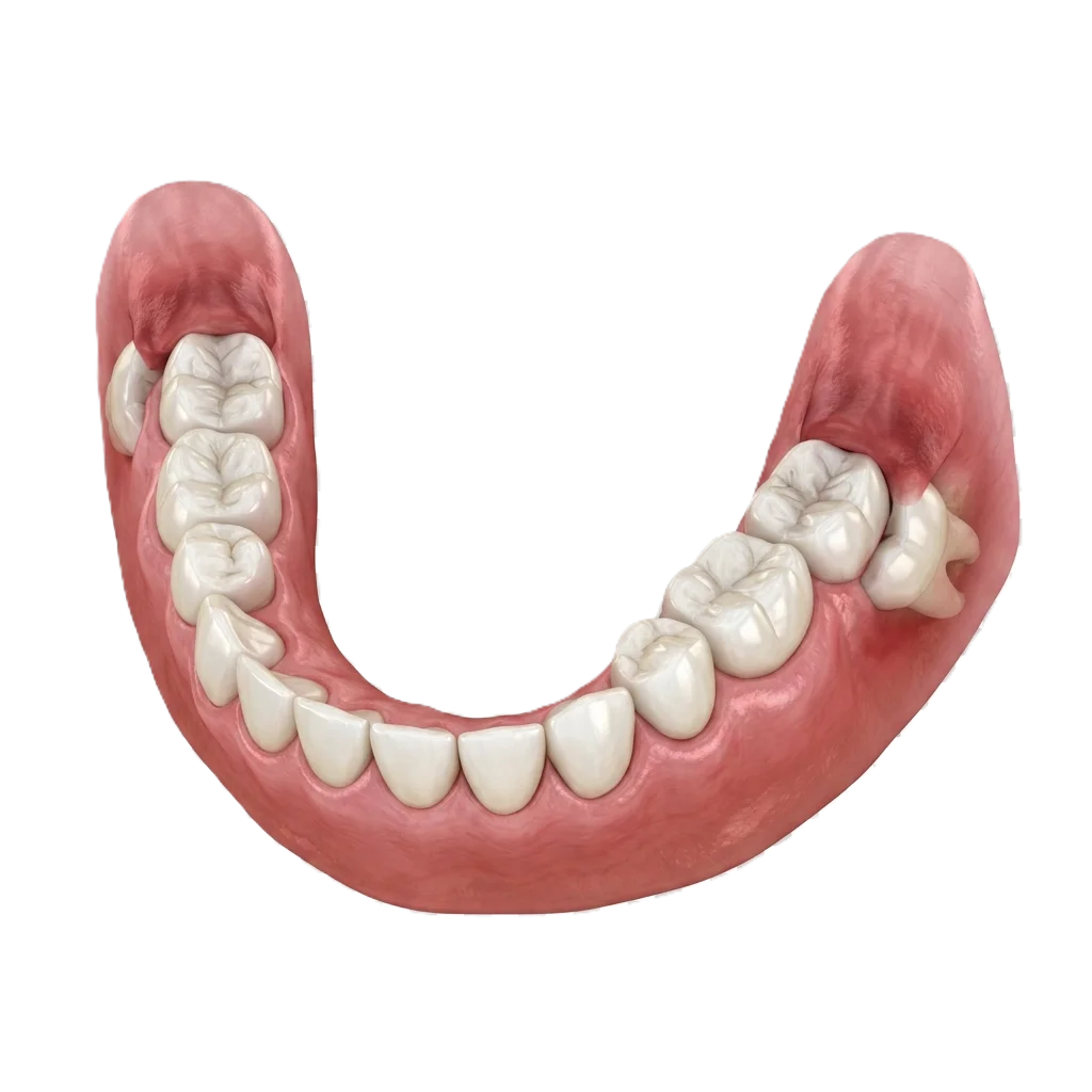 Arcada dental con las muelas del juicio a medio salir